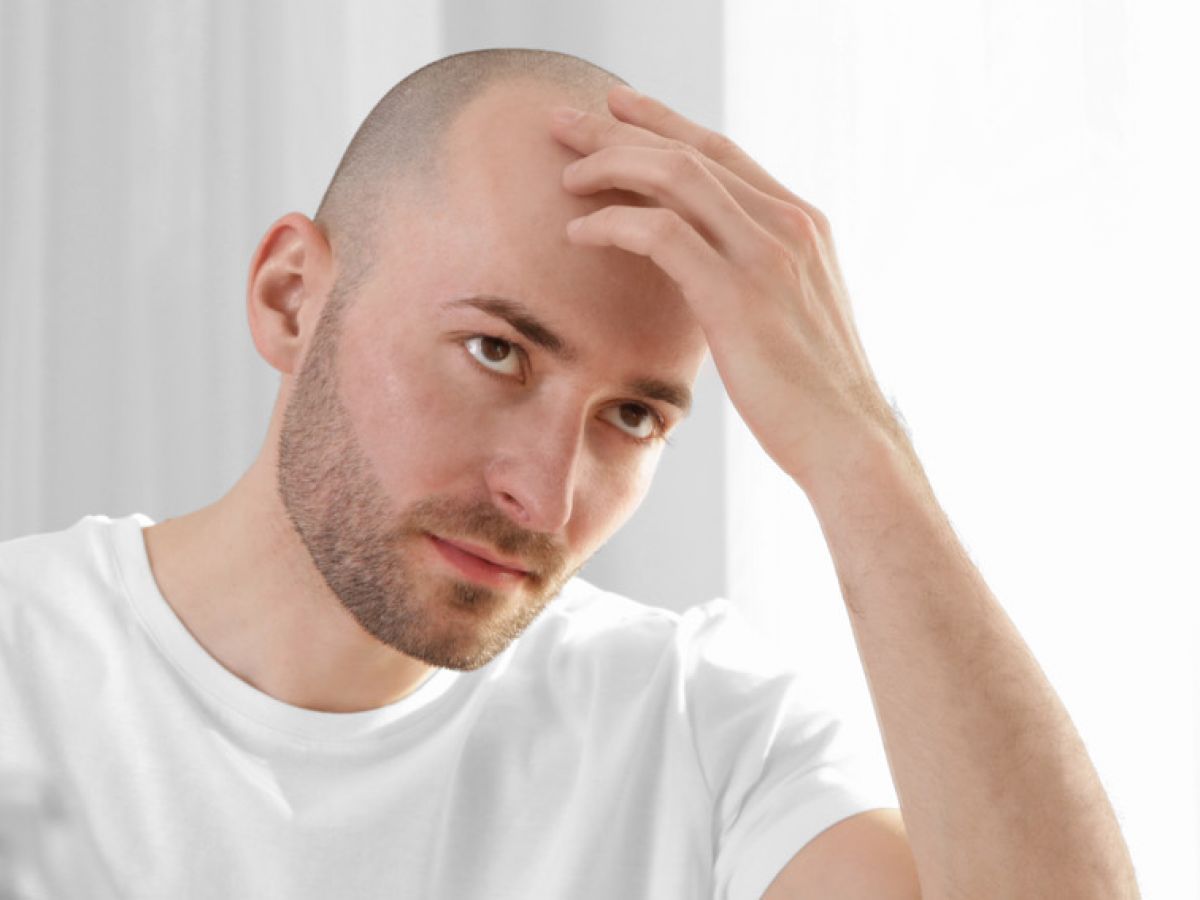 Qué motivos subyacen detrás de la alopecia por estrés