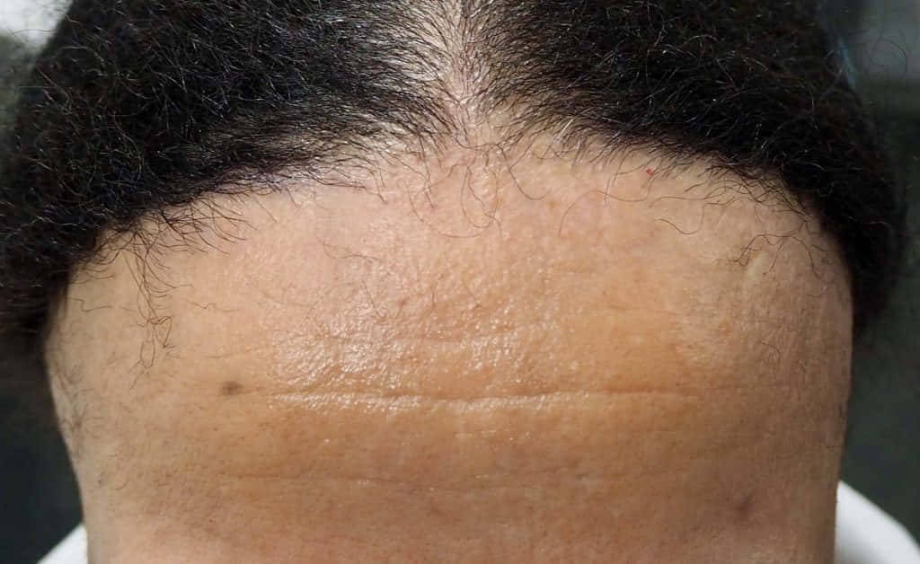 Hermanos Espíritu plan Qué es la alopecia frontal fibrosante? | Injercare Clínica Capilar
