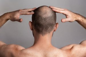tipos de alopecia