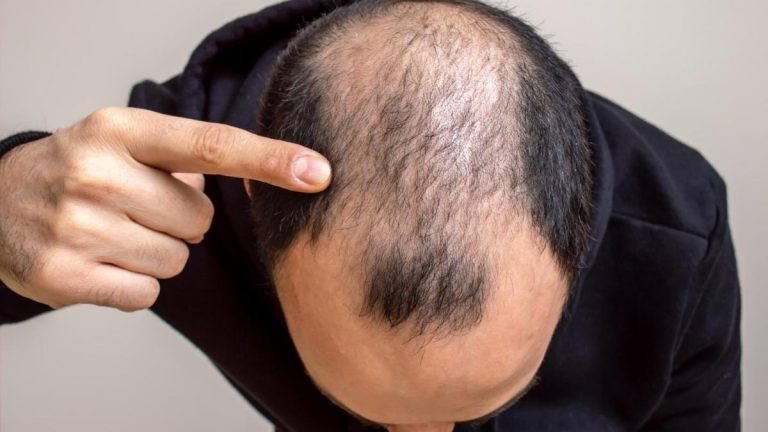 solución para la alopecia